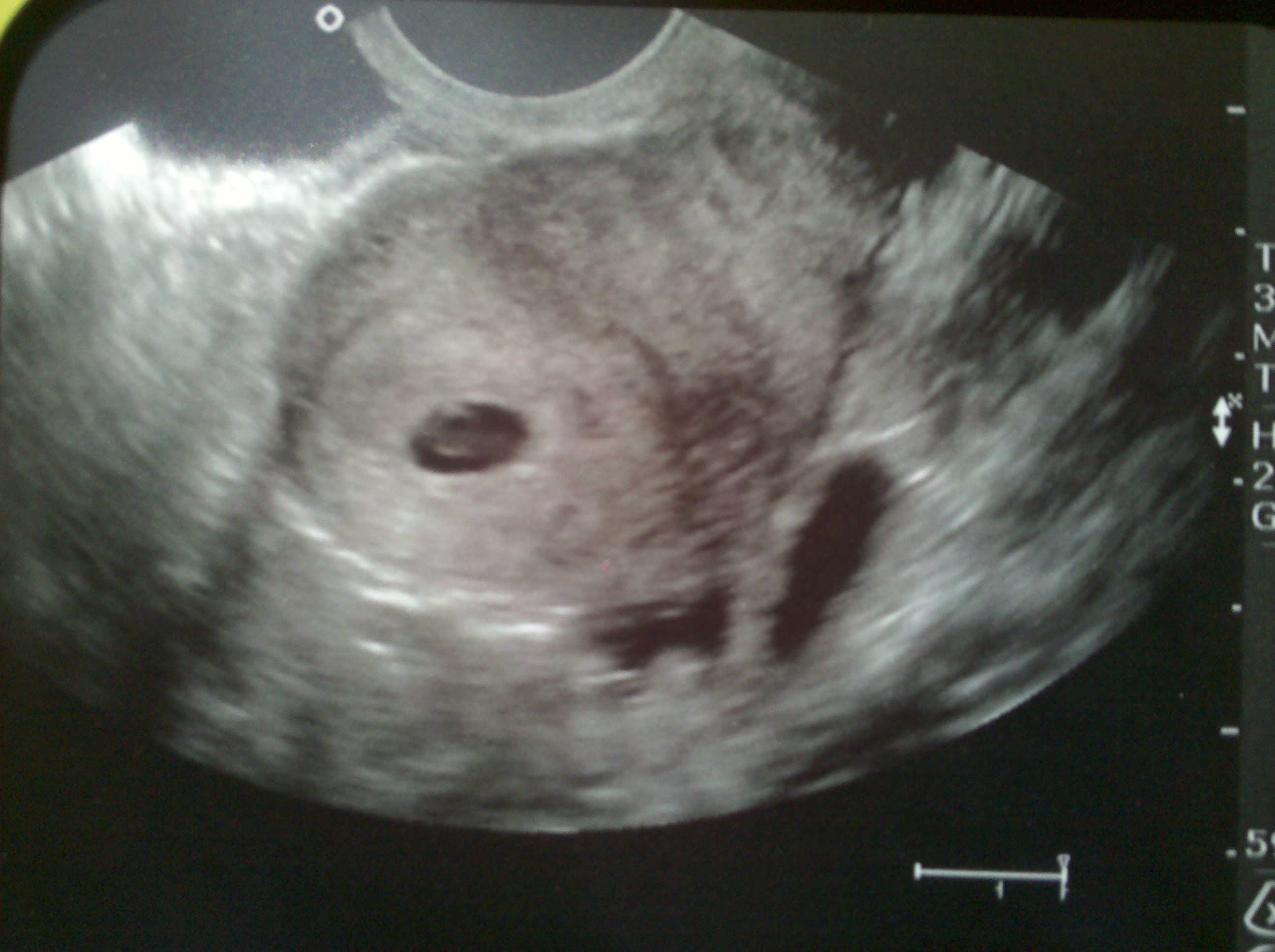 Зародыш 5 недель фото